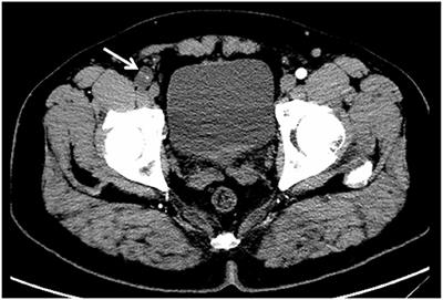 Cystic Adventitial Disease of the Common Femoral Artery: A Rare-Case Report